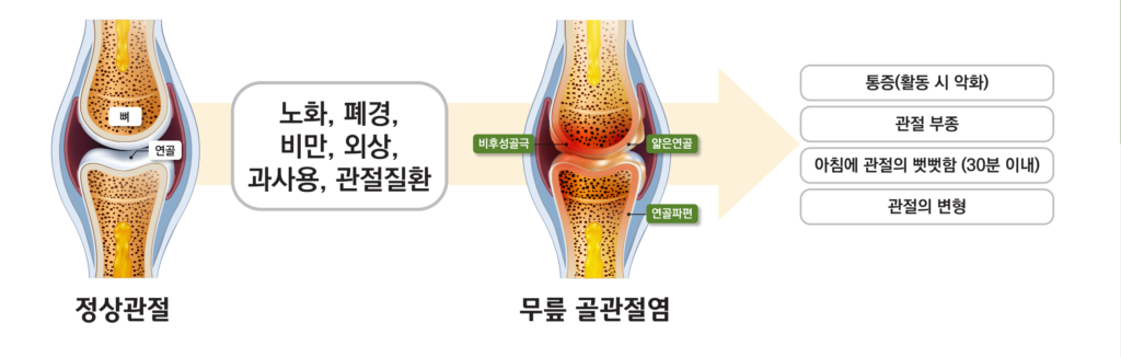퇴행성관절염 안내 그림